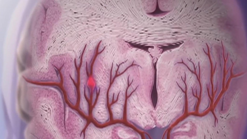 Knowing the signs of a stroke can save lives — Suwanee Community news